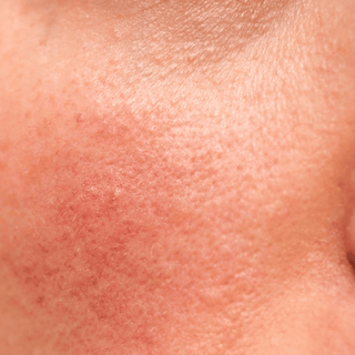 Creme e oli lenitivi per la pelle irritata e arrossata